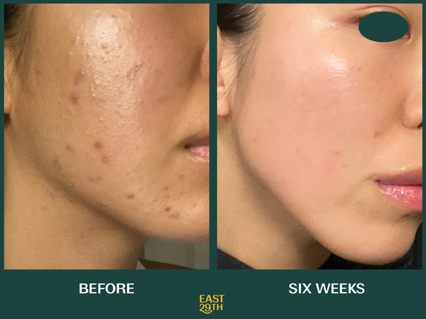 Clean Beauty for Teens: Natural Ingredients That Clear Acne Without Harsh Chemicals