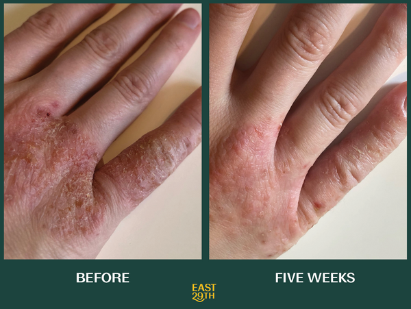 How Eczema Inspired an All Natural Skincare Line for Sensitive Skin